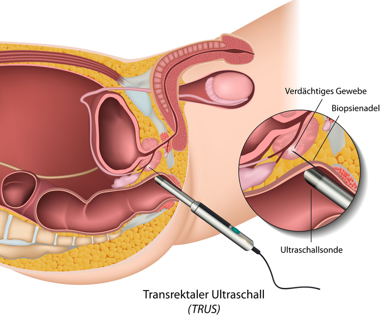 Transrektale Ultraschalluntersuchung (TRUS) der Prostata