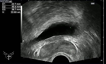 Echtzeitultraschallbild einer transrektalen Prostatabiopsie