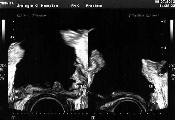 Transrektaler Ultraschall der Prostata (TRUS)